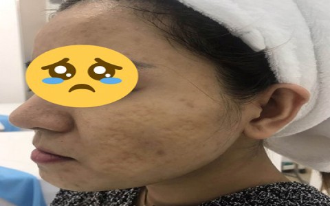 10 năm tìm cách trị sẹo rỗ và cái kết ngọt cùng Vy Paris Boutique